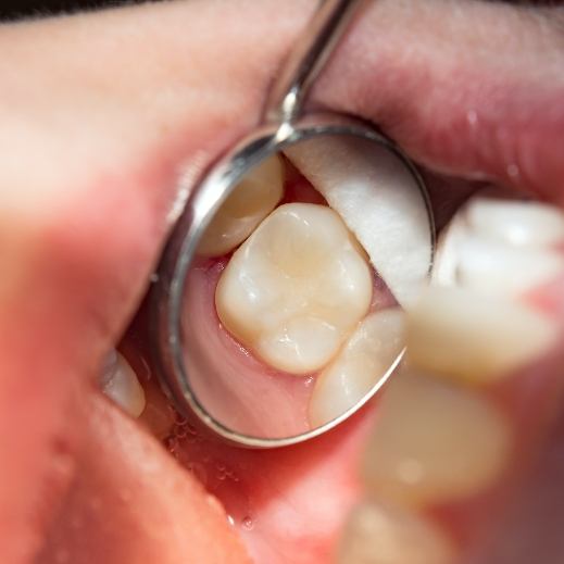 Dentist examining patient's smile after dental sealant application